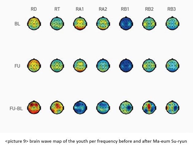 Altered Upper Alpha Brain Wave of Adolescents and Teachers – Maum Meditation(Ma-eum Su-ryun) Effects